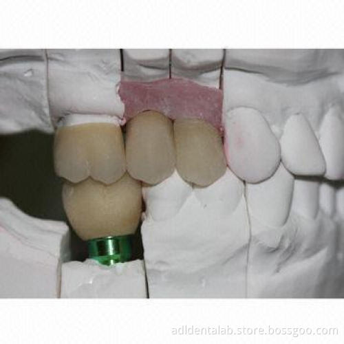 Implant crown, can last lifetime